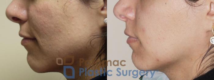 Before & After Botox Cosmetic Case 40 Left Side View in Washington DC & Arlington , DC