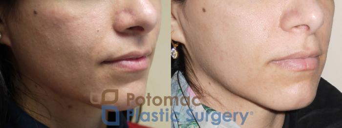 Before & After Botox Cosmetic Case 40 Right Oblique View in Washington DC & Arlington , DC