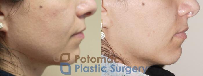 Before & After Facial Sculpting Case 40 Right Side View in Washington DC & Arlington , DC