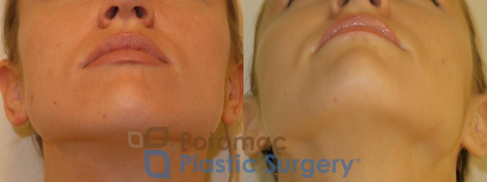 Before & After Liquid Facelift Case 71 Below View in Washington, DC