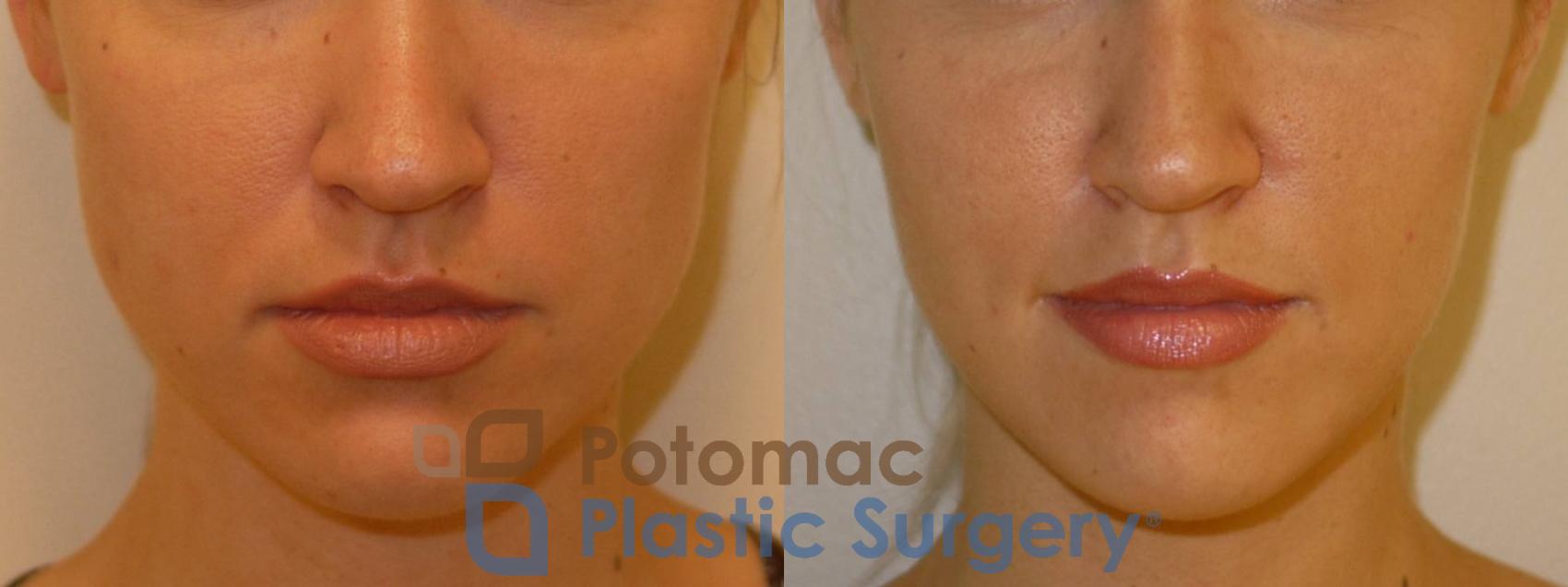 Before & After Facial Sculpting Case 71 Front View in Washington DC & Arlington , DC