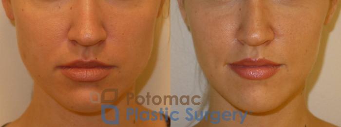 Before & After Botox Cosmetic Case 71 Front View in Washington, DC