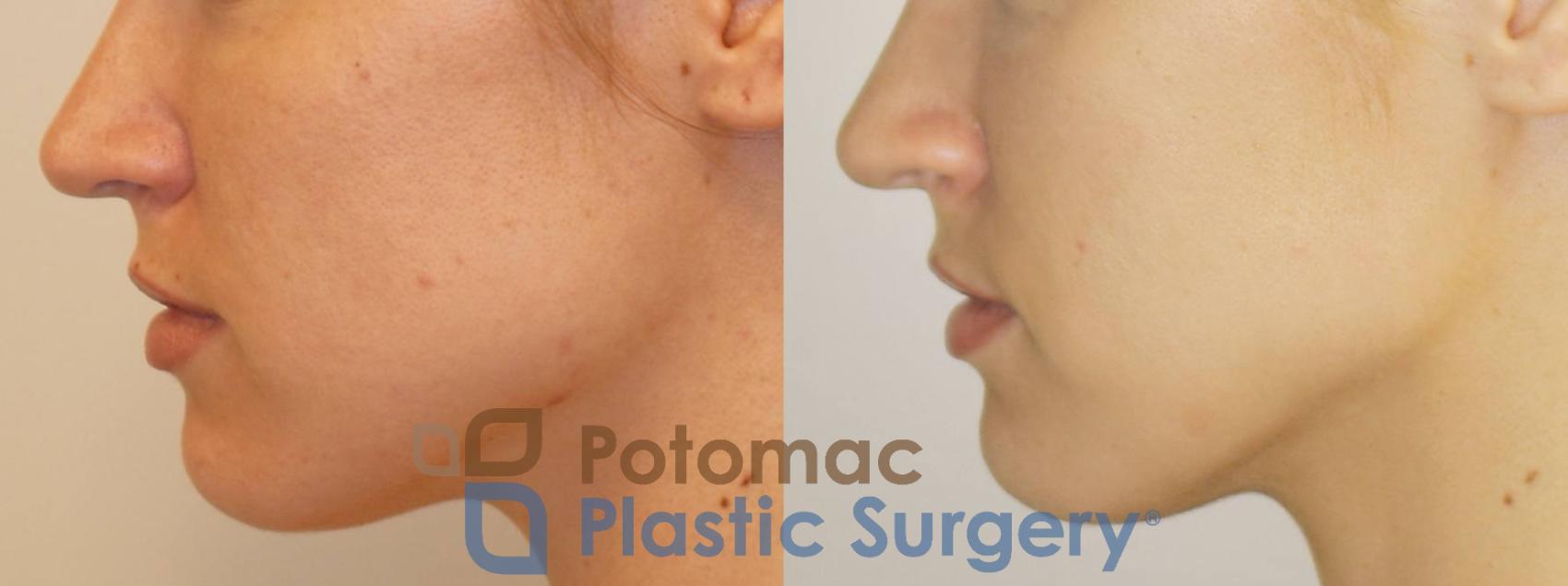 Before & After Liquid Facelift Case 71 Left Side View in Washington, DC