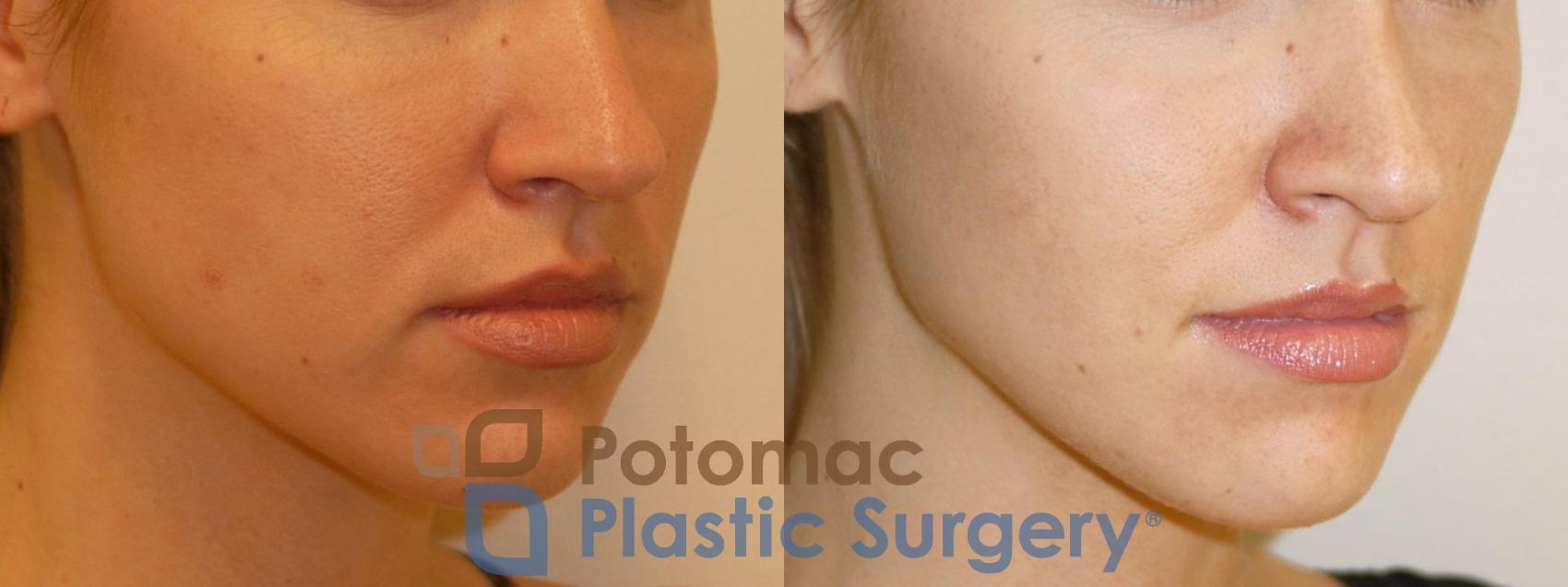 Before & After Liquid Facelift Case 71 Right Oblique View in Washington, DC