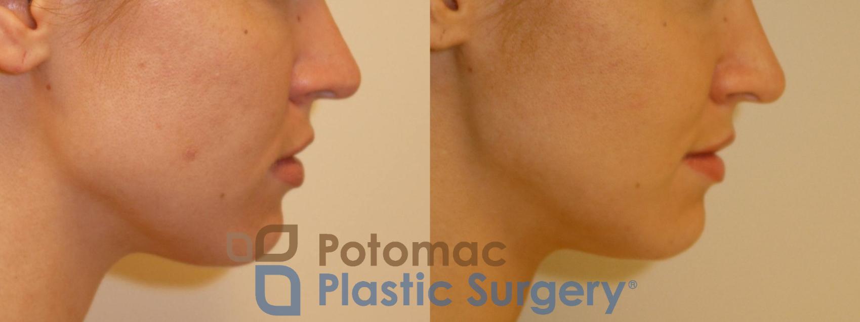 Before & After Facial Sculpting Case 71 Right Side View in Washington, DC