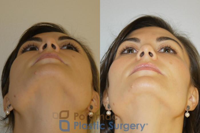 Before & After Botox Cosmetic Case 85 Below View in Washington, DC