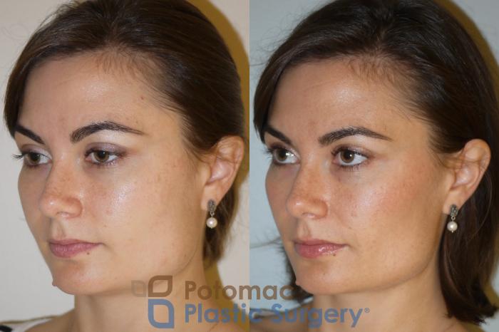 Before & After Botox Cosmetic Case 85 Left Oblique View in Washington, DC