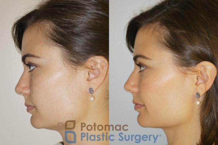 Before & After Botox Cosmetic Case 85 Left Side View in Washington, DC