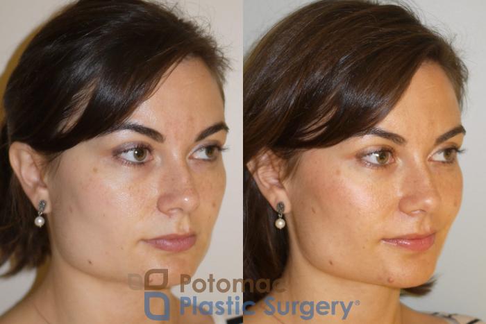 Before & After Botox Cosmetic Case 85 Right Oblique View in Washington, DC