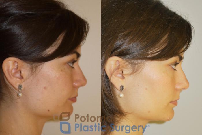 Before & After Botox Cosmetic Case 85 Right Side View in Washington, DC