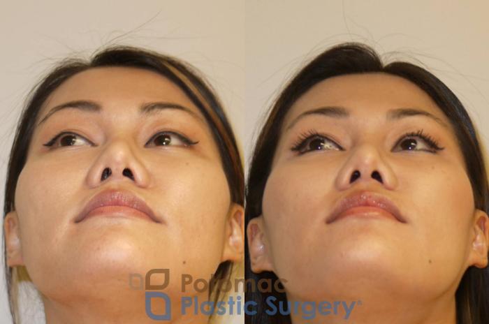 Before & After Facial Sculpting Case 93 Below View in Washington, DC