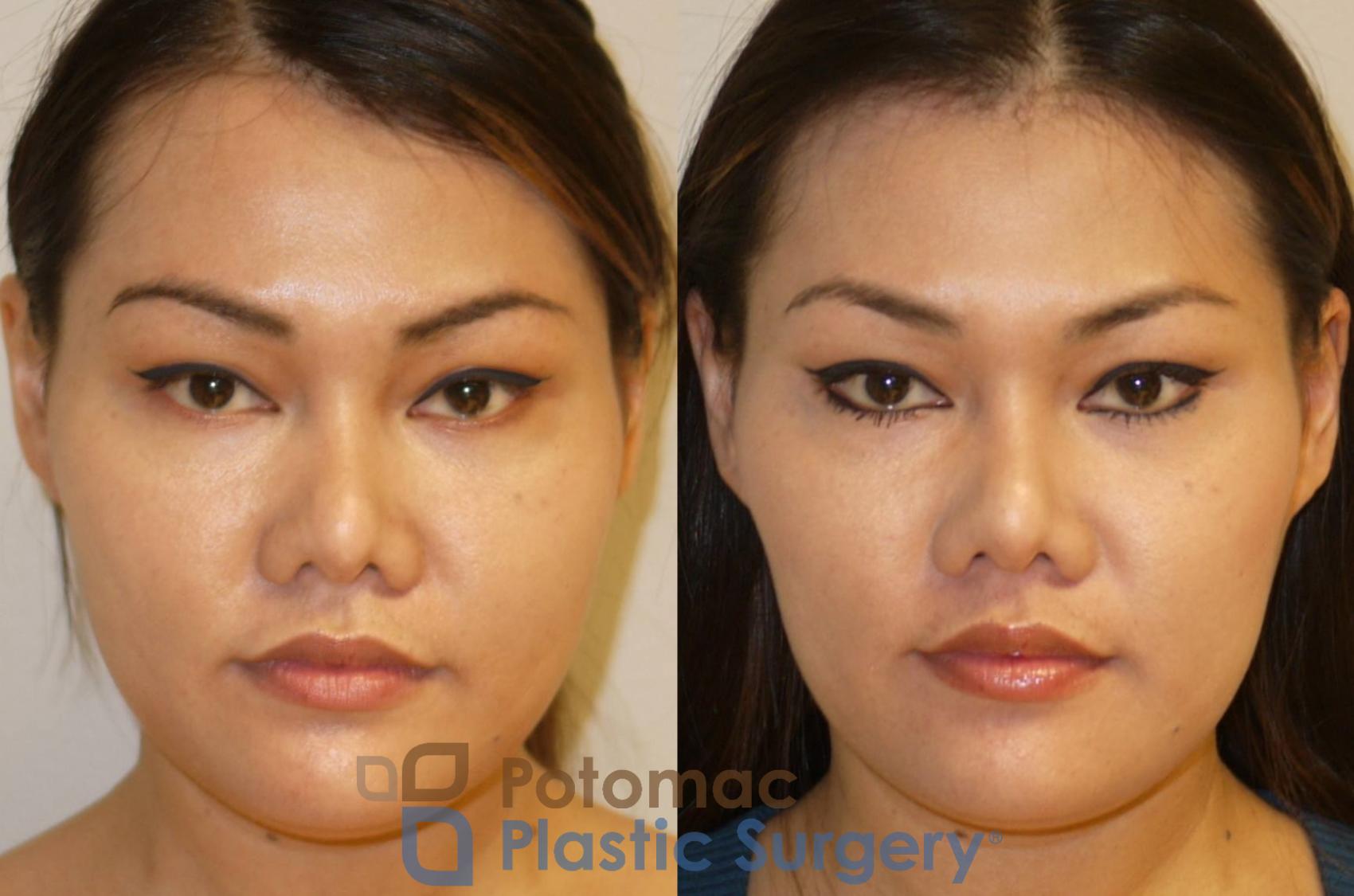 Before & After Liquid Facelift Case 93 Front View in Washington, DC