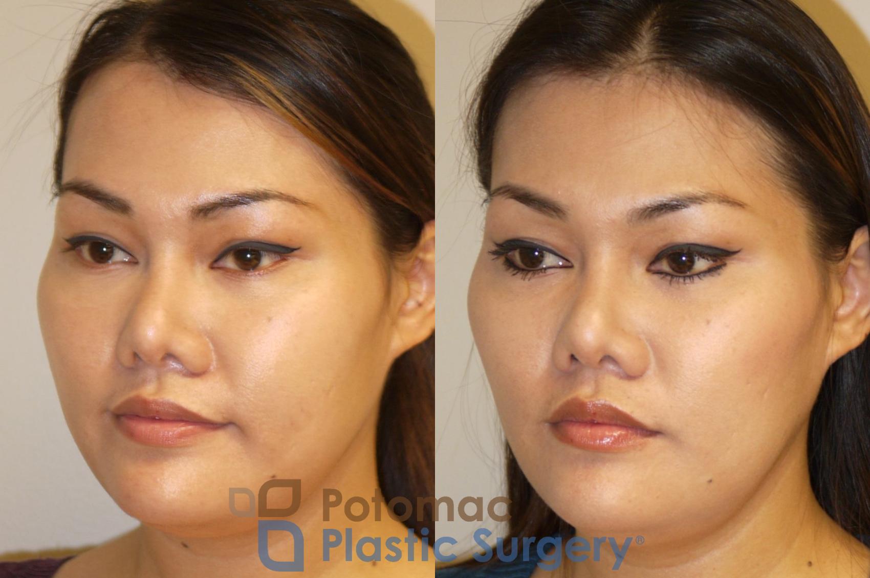 Before & After Facial Sculpting Case 93 Left Oblique View in Washington, DC