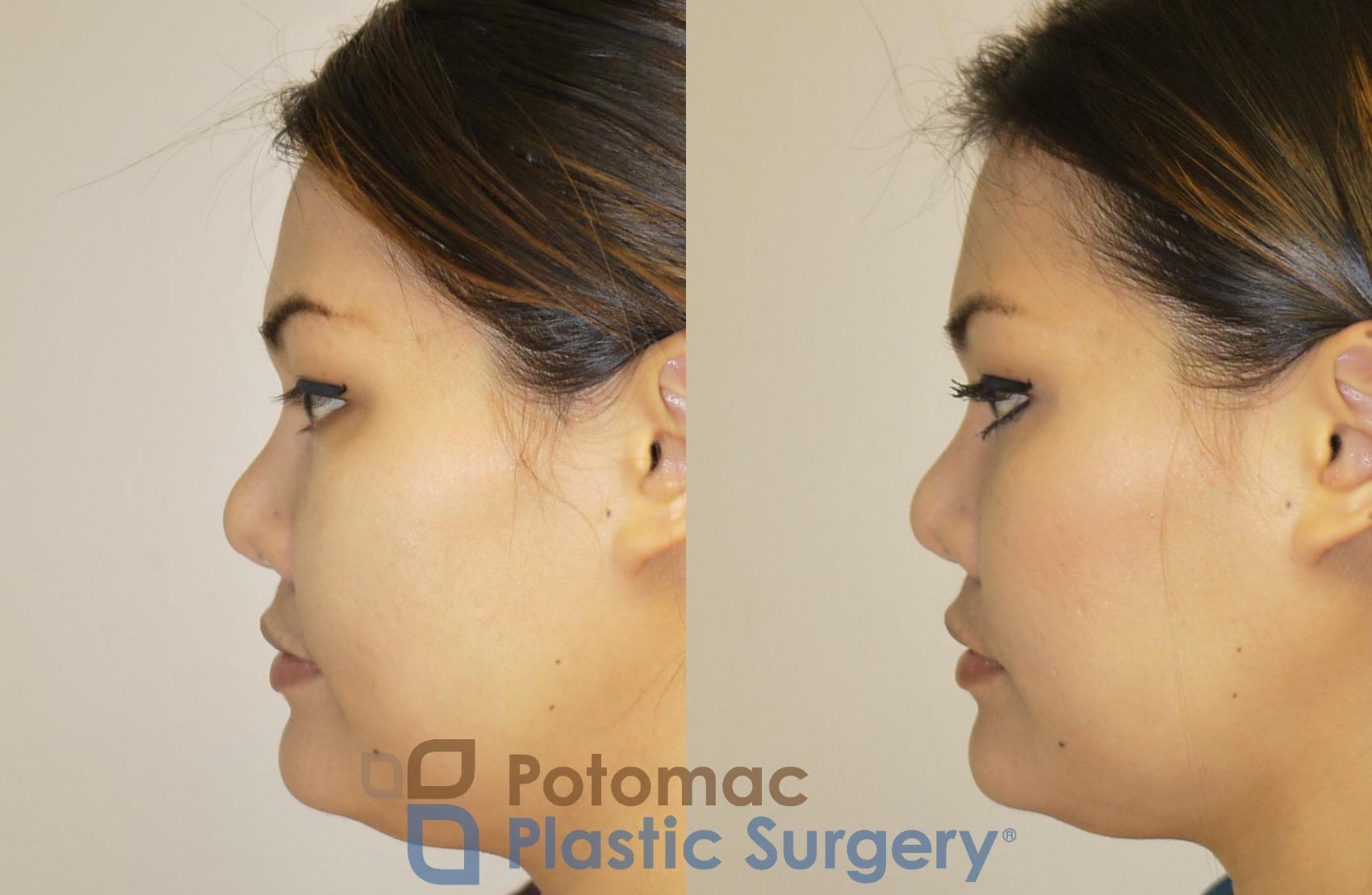Before & After Facial Sculpting Case 93 Left Side View in Washington, DC