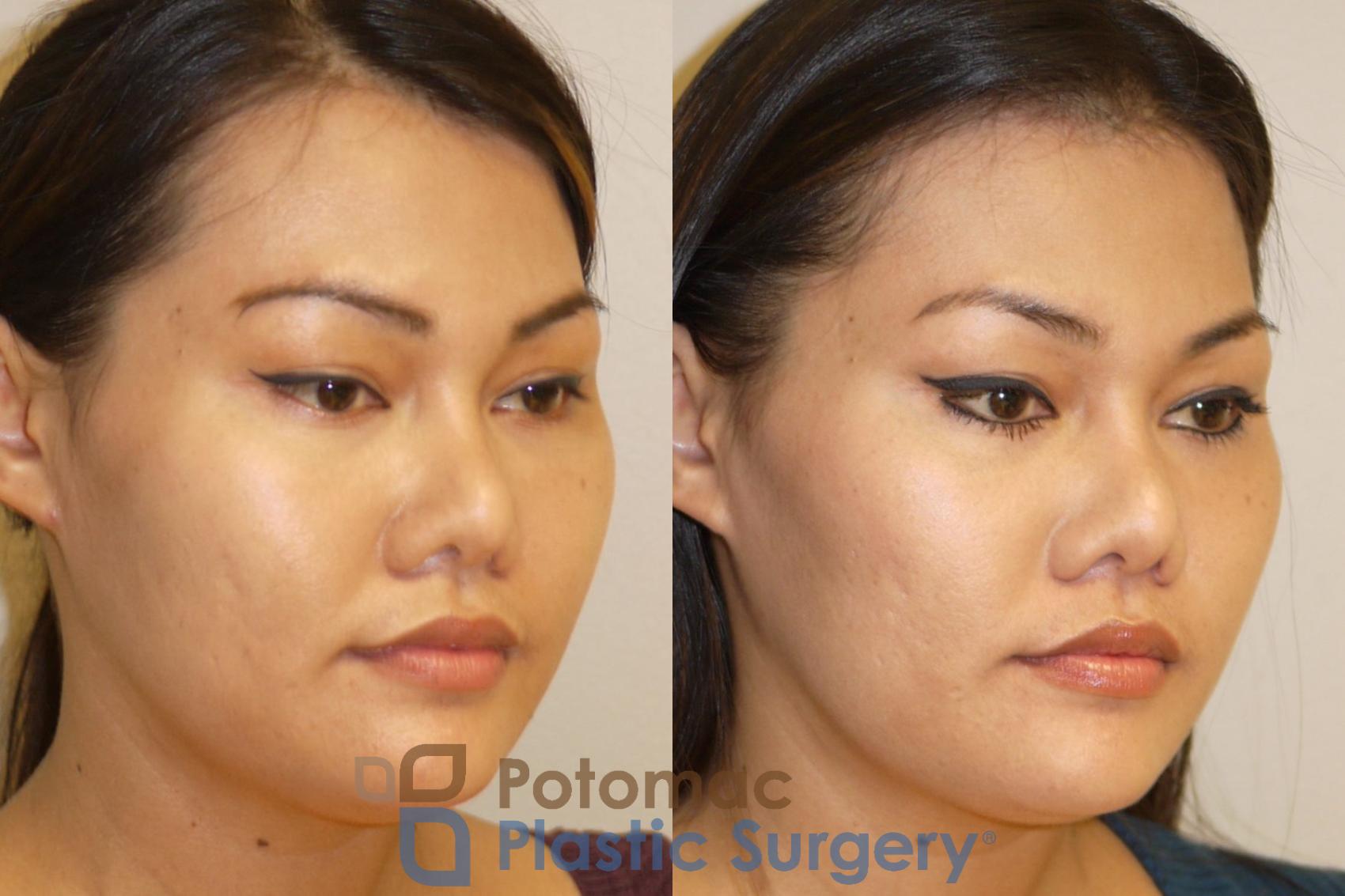Before & After Facial Sculpting Case 93 Right Oblique View in Washington, DC