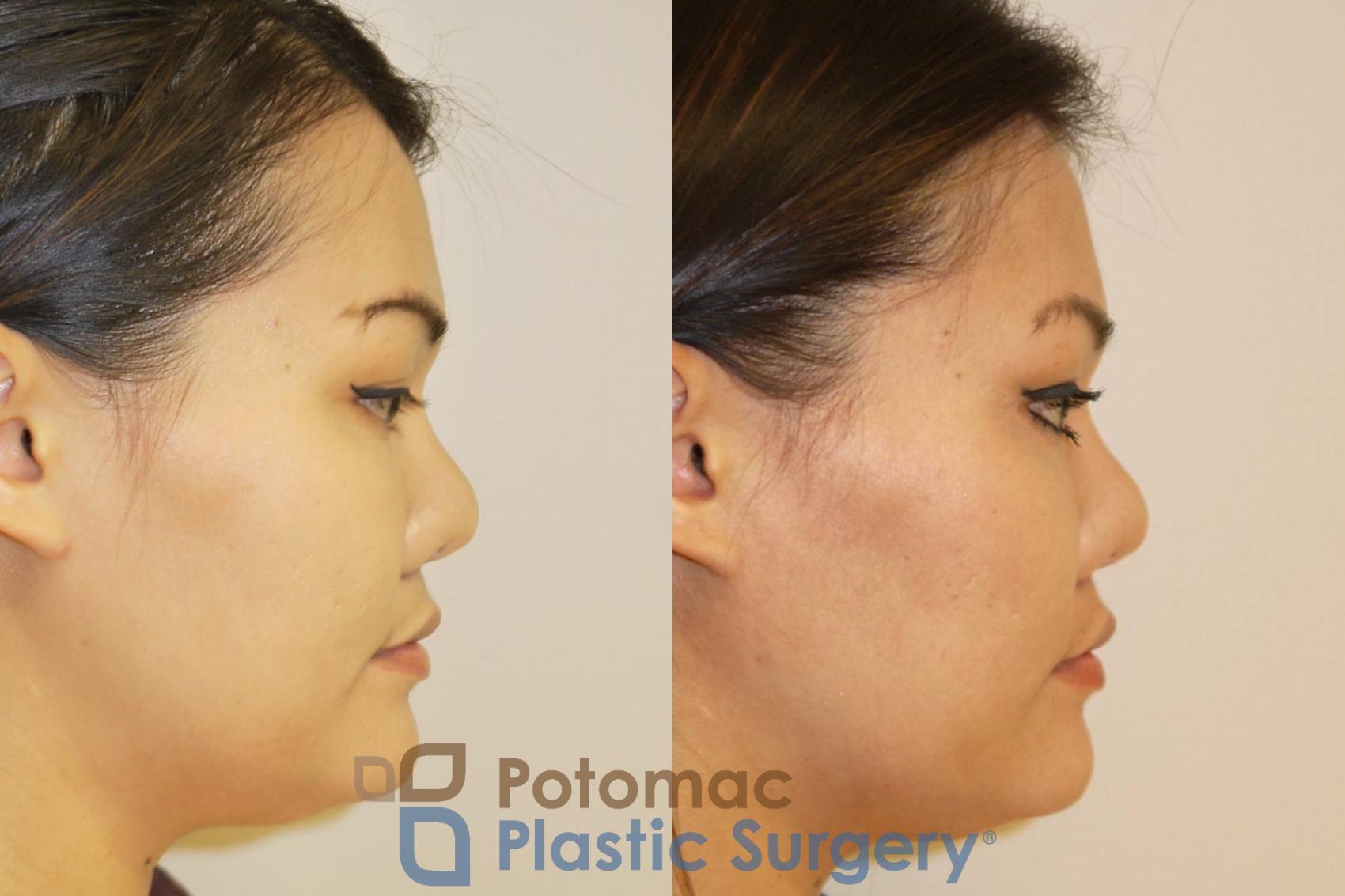 Before & After Facial Sculpting Case 93 Right Side View in Washington, DC