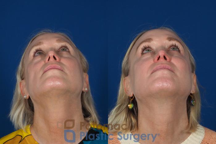 Before & After Lip Augmentation Case 244 Bottom View in Washington, DC