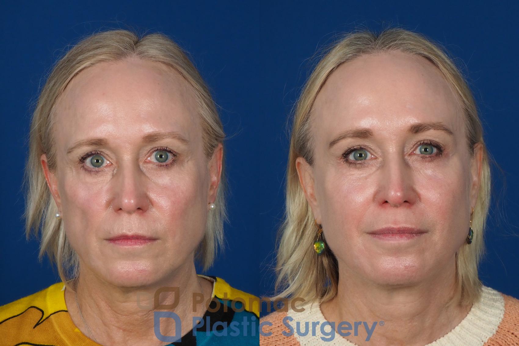 Before & After Lip Augmentation Case 244 Front View in Washington, DC