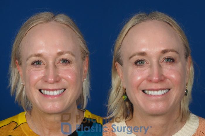 Before & After Facial Sculpting Case 244 Front - Smiling View in Washington DC & Arlington , DC