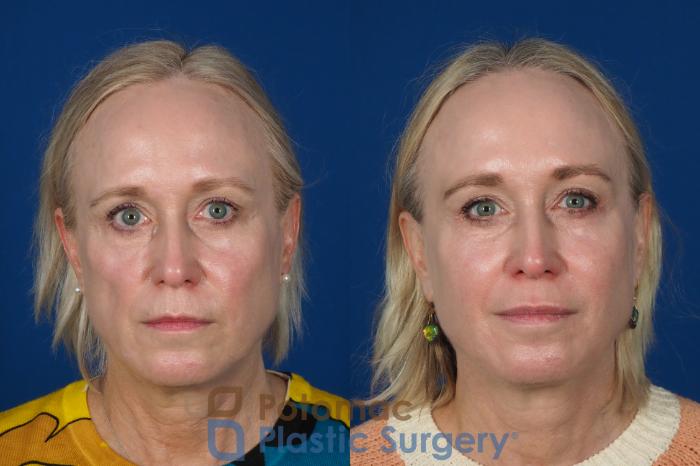 Before & After Facial Sculpting Case 244 Front View in Washington DC & Arlington , DC