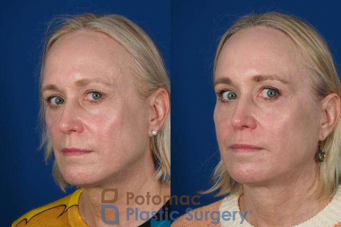 Before & After Lip Augmentation Case 244 Left Oblique View #2 View in Washington, DC