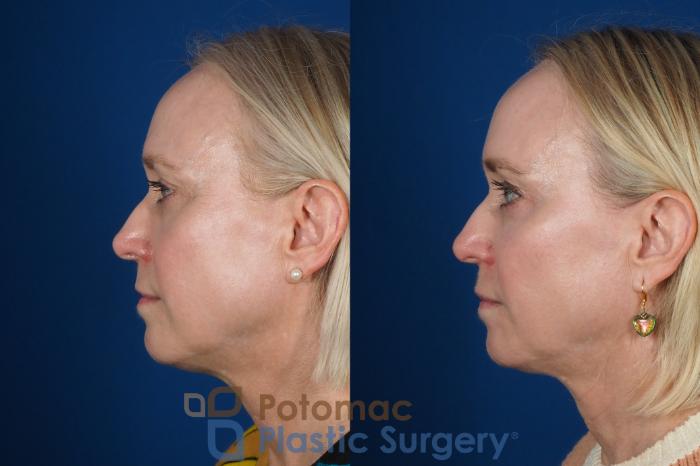 Before & After Facial Sculpting Case 244 Left Side View in Washington DC & Arlington , DC