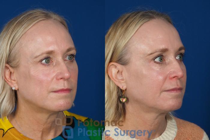 Before & After Facial Sculpting Case 244 Right Oblique View in Washington DC & Arlington , DC