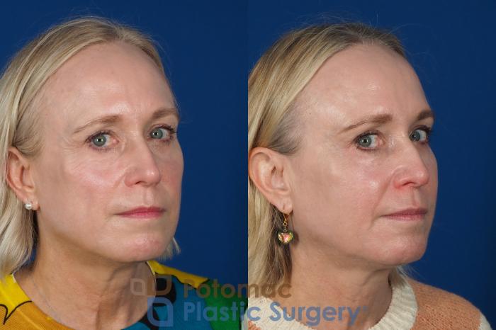 Before & After Facial Sculpting Case 244 Right Oblique View #2 View in Washington DC & Arlington , DC