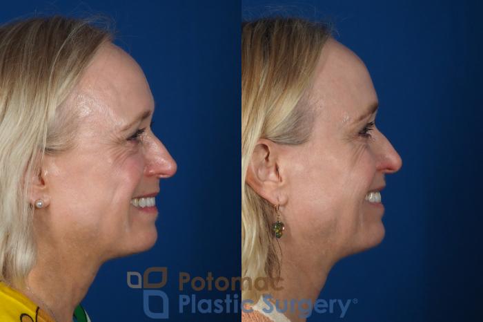 Before & After Lip Augmentation Case 244 Right Side - Smiling View in Washington, DC