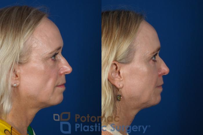 Before & After Facial Sculpting Case 244 Right Side View in Washington DC & Arlington , DC