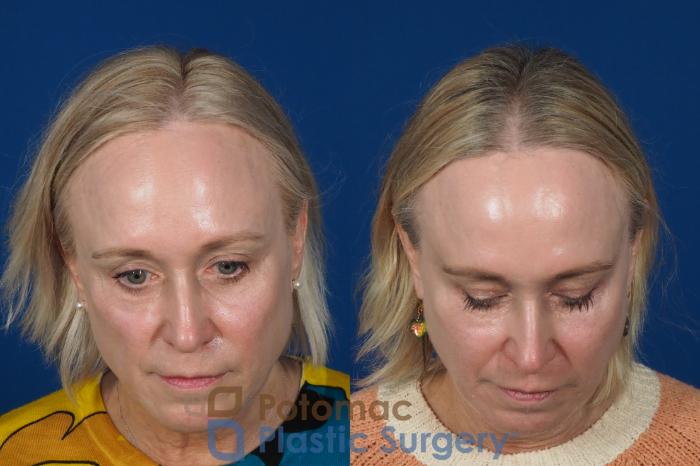 Before & After Facial Sculpting Case 244 Top View in Washington DC & Arlington , DC