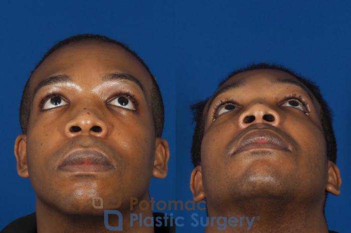 Before & After Facial Sculpting Case 286 Bottom View in Washington DC & Arlington , DC