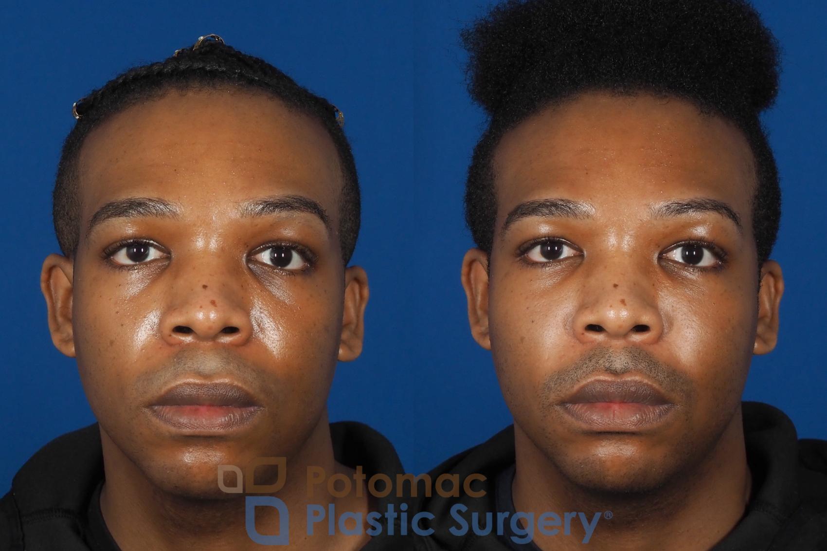 Before & After Facial Sculpting Case 286 Front View in Washington DC & Arlington , DC