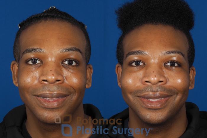 Before & After Facial Sculpting Case 286 Front - Smiling View in Washington DC & Arlington , DC