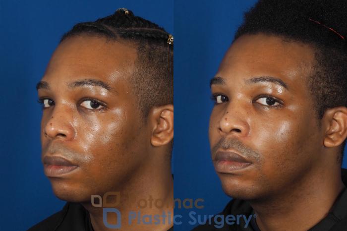 Before & After Facial Sculpting Case 286 Left Oblique 2 View in Washington DC & Arlington , DC