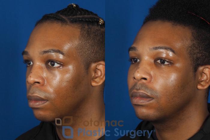 Before & After Facial Sculpting Case 286 Left Oblique View in Washington DC & Arlington , DC