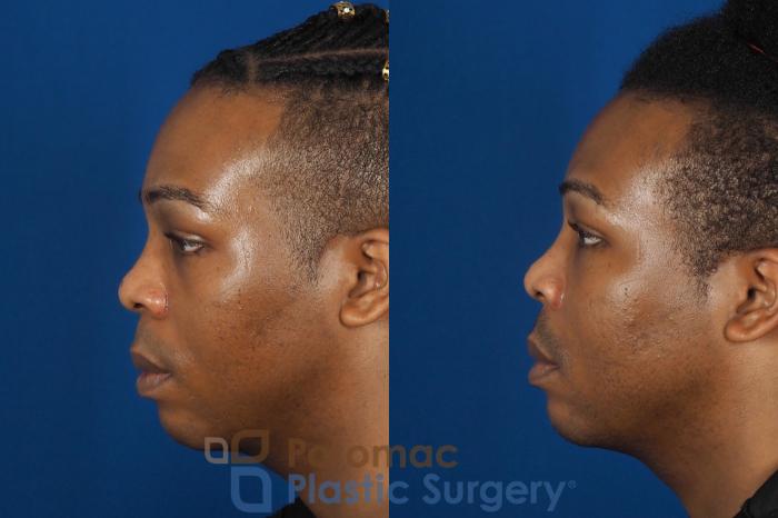 Before & After Facial Sculpting Case 286 Left Side View in Washington DC & Arlington , DC