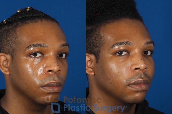 Before & After Facial Sculpting Case 286 Right Oblique 2 View in Washington DC & Arlington , DC