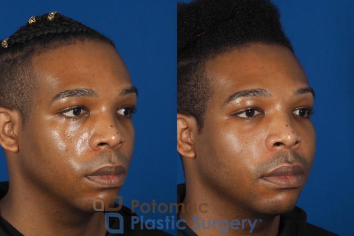 Before & After Facial Sculpting Case 286 Right Oblique View in Washington DC & Arlington , DC