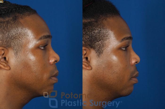 Before & After Facial Sculpting Case 286 Right Side View in Washington DC & Arlington , DC