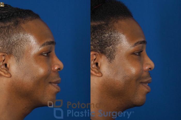 Before & After Facial Sculpting Case 286 Right - Smiling View in Washington DC & Arlington , DC