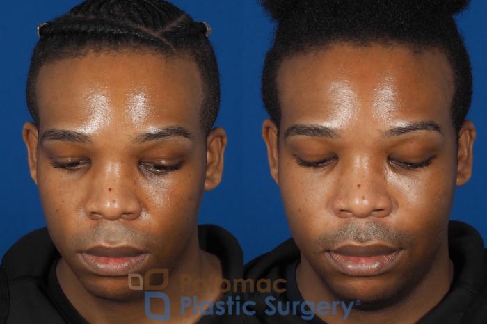 Before & After Facial Sculpting Case 286 Top View in Washington DC & Arlington , DC