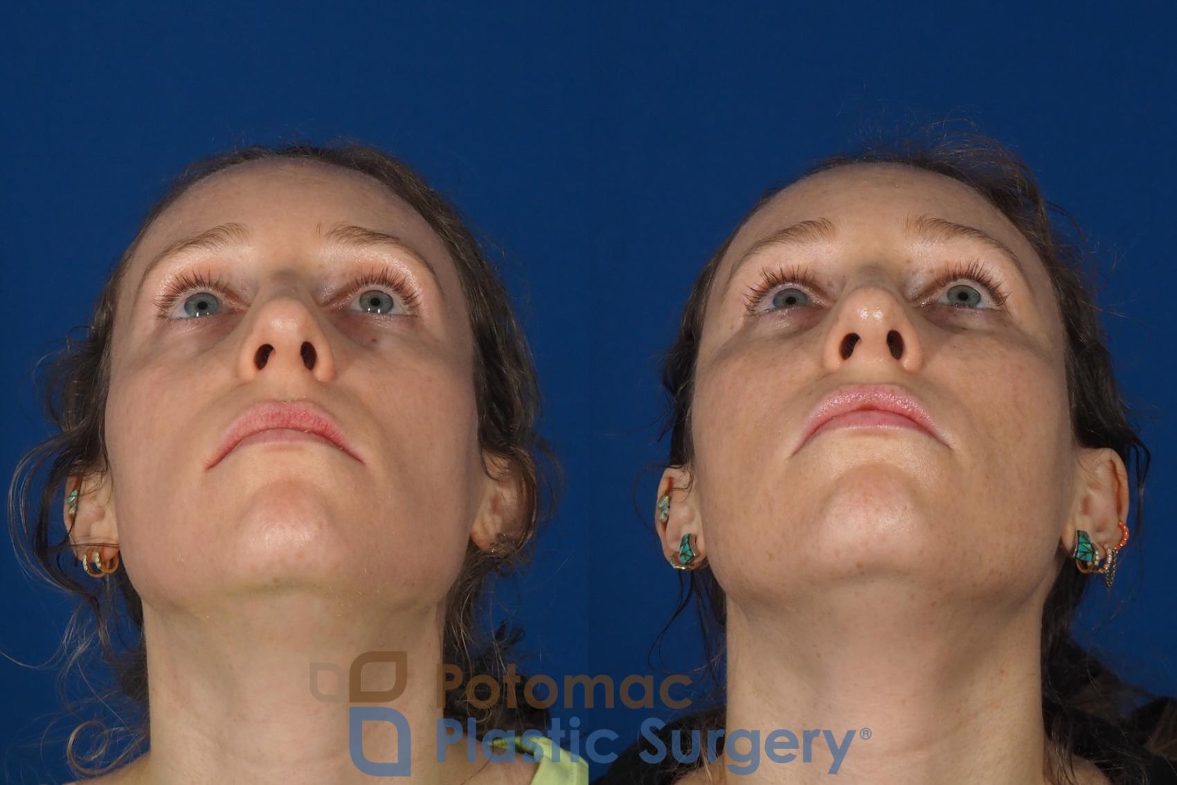 Before & After Facial Sculpting Case 316 Bottom View in Washington DC & Arlington , DC
