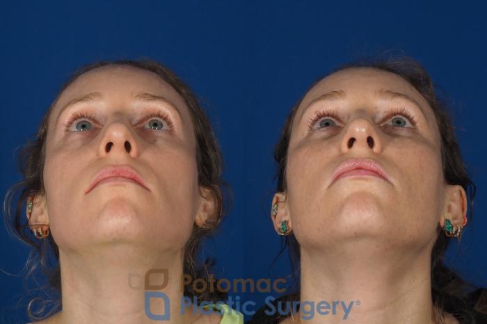 Before & After Blepharoplasty (Eyelid Surgery) Case 316 Bottom View in Washington DC & Arlington , DC