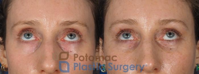 Before & After Blepharoplasty (Eyelid Surgery) Case 316 Close up 2 View in Washington DC & Arlington , DC