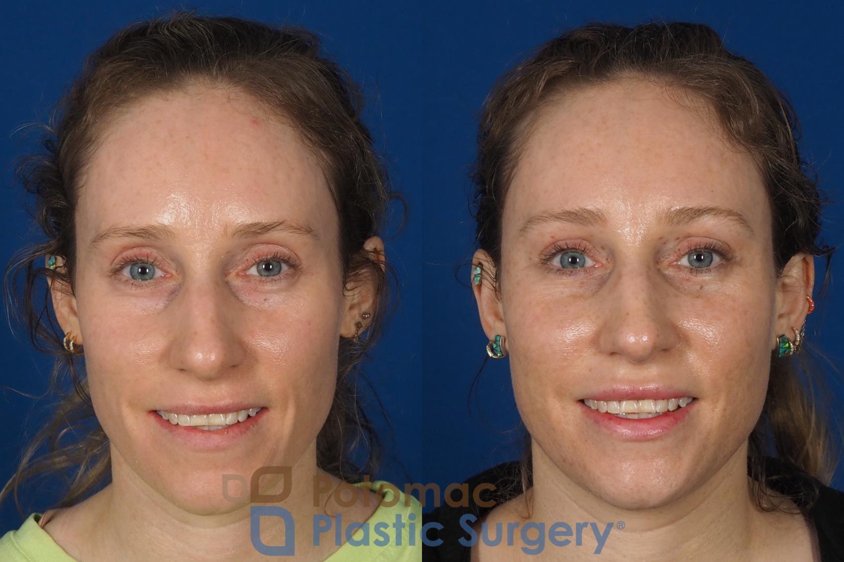 Before & After Facial Sculpting Case 316 Front - Smiling View in Washington DC & Arlington , DC