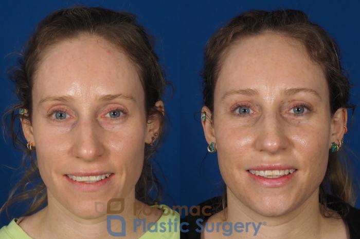 Before & After Blepharoplasty (Eyelid Surgery) Case 316 Front - Smiling View in Washington DC & Arlington , DC