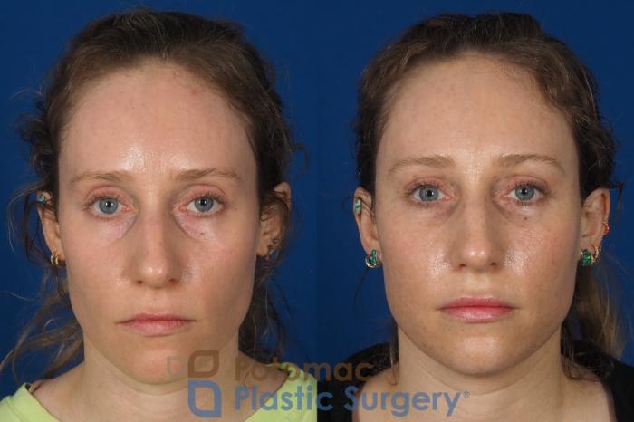 Before & After Blepharoplasty (Eyelid Surgery) Case 316 Front View in Washington DC & Arlington , DC