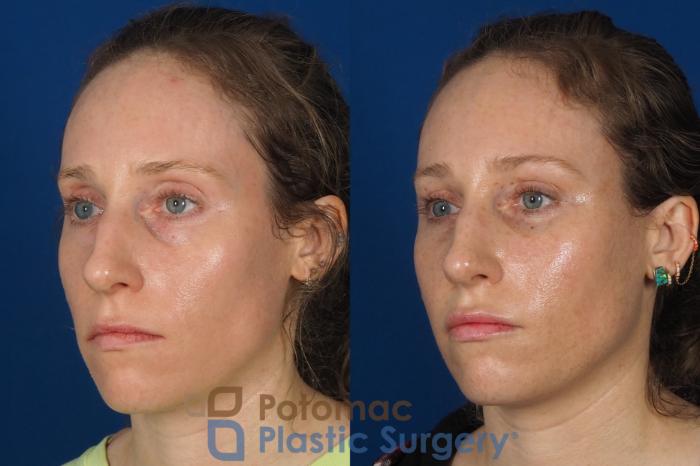 Before & After Blepharoplasty (Eyelid Surgery) Case 316 Left Oblique View in Washington DC & Arlington , DC