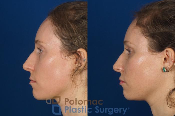 Before & After Blepharoplasty (Eyelid Surgery) Case 316 Left Side View in Washington DC & Arlington , DC